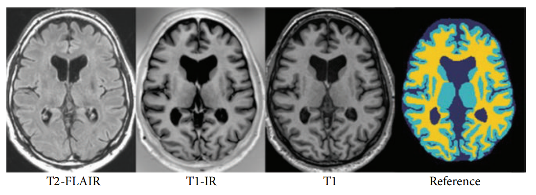 Preview for Brain matter segmentation in MRI
