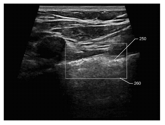 Preview for Automatic pneumothorax detection in ultrasound