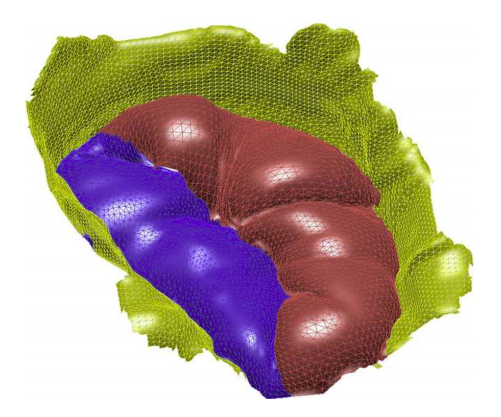 Preview for Preoperative planning tool for heart valve surgery