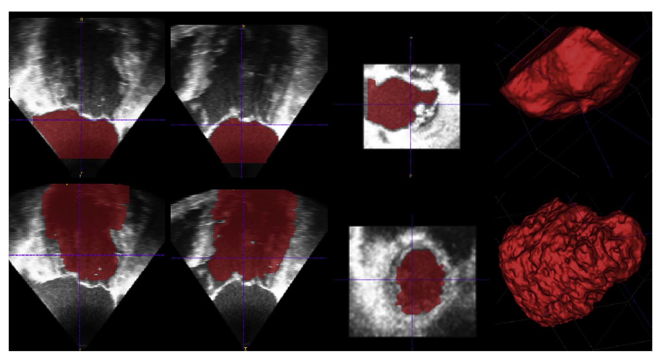 Preview for Heart wall segmentation from 3D transesophageal ultrasound